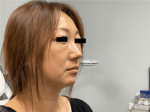 Agnes RF Facelift case study