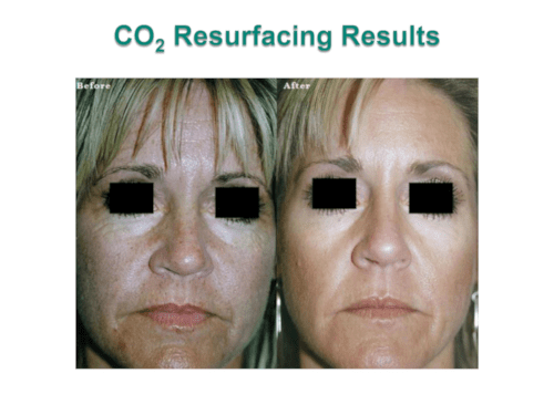 CO₂ Laser Resurface case study