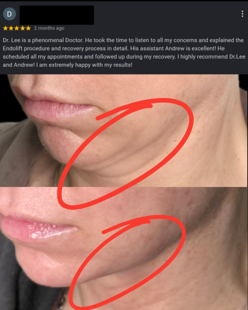 Endolift comparison 1