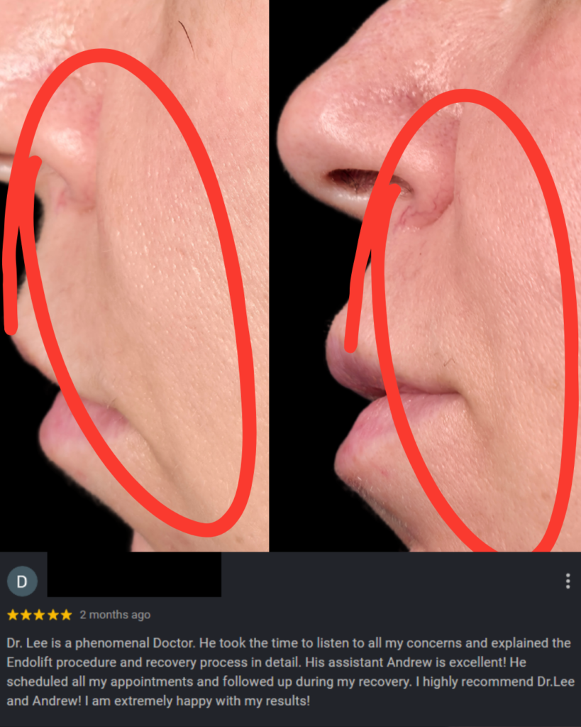 Endolift comparison 2
