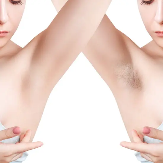 Laser Hair Removal case study