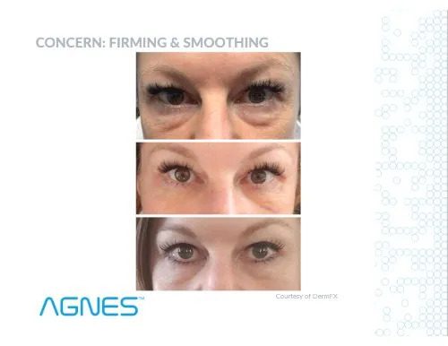 Lower Eyelift case study