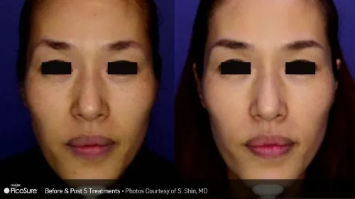 PicoSure Laser case study