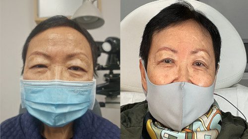 Upper Eyelift case study